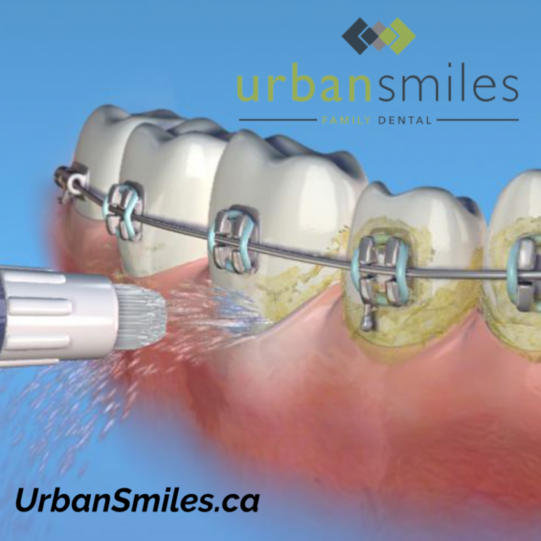 What is a Waterpik WaterFlosser and how does it work? Urban Smiles